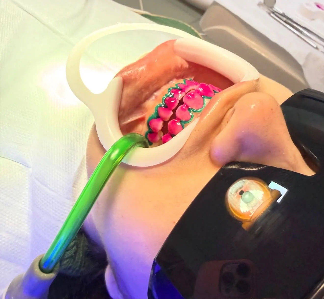 Clareamento dental em consultório